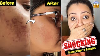 Subscribers Magical Skincare Challenge  Strongest Remedy To Remove Dark SpotsAcne Pimples Marks💕 [upl. by Kip]