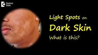 LIGHT SPOTS amp PATCHES ON BROWN OR DARK SKIN Causes amp Treatment  DrNischal K  Doctors Circle [upl. by Griffy]