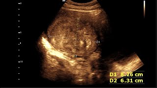 Uterine leiomyoma  Fibroid Uterus  FIGO Classification [upl. by Anoirtac379]