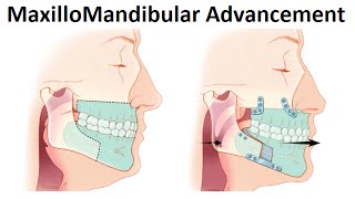 Surgical Treatment of Retruded Jaws MaxilloMandibular Advancement Surgery by Dr Mike Mew [upl. by Chil]