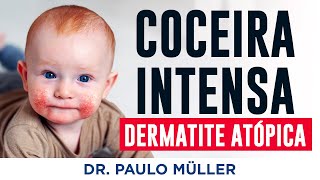 Coceira Crônica  Tudo Sobre Dermatite Atópica  Dr Paulo Muller Dermatologista [upl. by Iznyl]