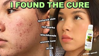 How to fix ACNE RED MARKS ampTEXTURED SKIN in 1 week it works [upl. by Brandon213]