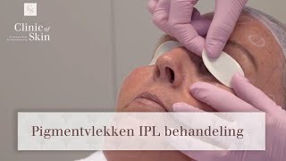 Pigmentvlekken IPL behandeling [upl. by Anwahsad]