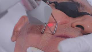 Rejuvenecimiento Facial y eliminar manchas con el Laser CO2 Fraccionado DEKA ⚡Trujillo Perú [upl. by Earleen]