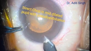 Direct Chop in Mid Dilated Pupil with Pseudoexfoliation [upl. by Ahserak]