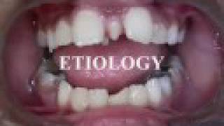 Clinical Pediatric Dentistry Etiology of Supernumerary Teeth [upl. by Rosalind]