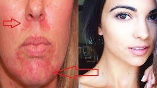 Home Remedies for Perioral Dermatitis Get Rid Red Bumps Around the Mouth [upl. by Moina]