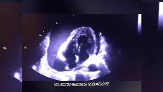 Massive Pericardial Effusion  This is how electrical alternans produced on ECG [upl. by Iaka733]