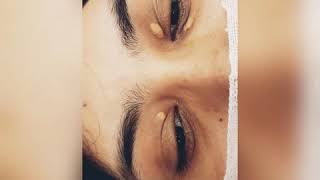 Xanthelasma Removal [upl. by Conrad]