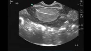 How to Female Transvaginal Ultrasound Exam [upl. by Ewald]