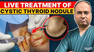 Live Treatment of Cystic Thyroid Nodule by Ethanol Ablation NonSurgical Procedure [upl. by Aicil]