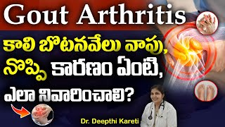 Gout Causes Symptoms And Treatments  గౌట్  తగ్గించుకునే మార్గాలు  Dr Deepthi Kareti [upl. by Ailin109]