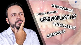 GENGIVOPLASTIA GENGIVECTOMIA CIRURGIA GENGIVAL SAIBA A DIFERENÇA drrowanvilar [upl. by Nwotna]