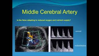 Obstetric Doppler Part 2 [upl. by Moreville]