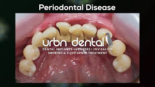 furcation involvement in periodontal disease [upl. by Henryk62]