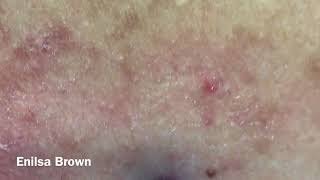 Christians Acne Back Treatment Blackheads Extractions [upl. by Narat]