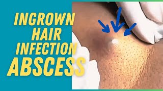 POKE SQUEEZE POP Ingrown Hair Infection Abscess Boil  Out Comes the Hair and Pus [upl. by Nelleoj75]