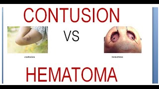 Surgery 011 Wound Contusion Hematoma Difference Vs Compare Between [upl. by Adalheid]