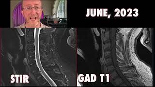 Scary Spinal MRI Multiple Sclerosis Spinal Cord [upl. by Atikihs194]