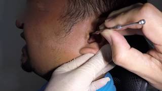 Attempting to Remove Mans Hardened Blocked Earwax [upl. by Reilly]