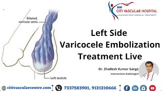 Varicocele Embolization Treatment Live  Varicocele Surgery Honest Video  Varicocele Specialist [upl. by Stambaugh]