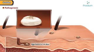 Scabies Predisposing factors Pathogenesis Types Clinical features Diagnosis Treatment [upl. by Bertha]