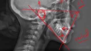 12 Tweed triangle Cephalometric analysis [upl. by Annair]