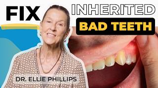 Inherited Bad Teeth You Can Fix Them [upl. by Nnaassilem]