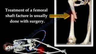 Fracture of the Femur and its fixation  Everything You Need To Know  Dr Nabil Ebraheim [upl. by Yralih215]