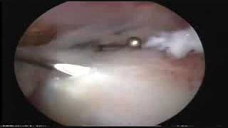 Arthroscopic Release of Calcific Deosit of Shoulder [upl. by Amiarom]