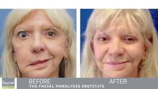 Masseter Facial Nerve Transfer  Expert Facial Paralysis Surgeon  Dr Azizzadeh [upl. by Daas]