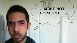 How to NOT Scratch Eczema  Dermatitis  Psoriasis [upl. by Eislrahc185]