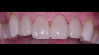 Veneers at Dental Alvarez [upl. by Mazlack]