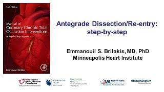 Antegrade dissection and reentry stepbystep [upl. by Annirak]