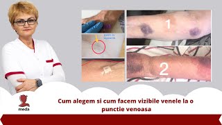 Cum facem alegerea venelor si cum le facem vizibile la o punctie venoasa [upl. by Anait]