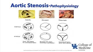 Valvular Heart Disease  Dr Schell [upl. by Zetnauq708]