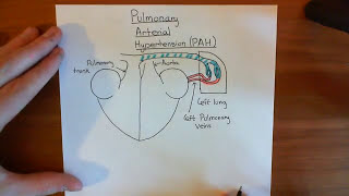 Pulmonary Hypertension Part 1 [upl. by Putscher]