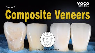 Anterior Composite Veneers Restoration with Layering Technique  AMARIS VOCO GmbH [upl. by Doelling]