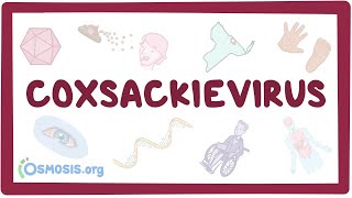 Coxsackievirus  an Osmosis Preview [upl. by Yenitsed]