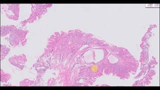 Autoimmune gastritis with hyperplastic polyp [upl. by Drarig]