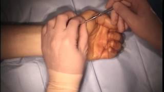 Transtrapezial Approach for Fixation of Acute Scaphoid Fractures [upl. by Nitniuq786]