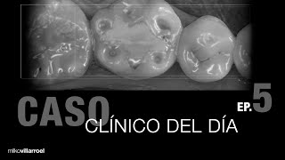 Dientes posteriores  CasoClínicoDelDía  Milko Villarroel [upl. by Gnah]