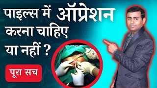 पाइल्स में ऑप्रेशन करना चाहिए या नहीं  पूरा सच when do piles need surgery piles pilesclinic [upl. by Gracye]