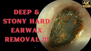 DEEP amp Stony HARD Earwax Removal Very Satisfying Video [upl. by Oglesby]