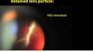 YAG vitreolysis for retained lens particle after cataract surgery [upl. by Ryan658]