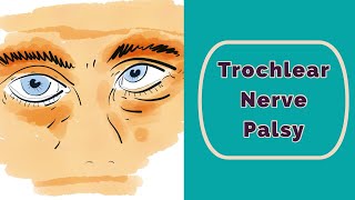 Trochlear Nerve Palsy Rapid Review [upl. by Cesaro]