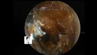 Reexamination of cholesteatoma of the external auditory canal 20220516 [upl. by Adiell]