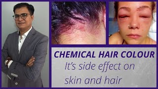 Chemical Hair Colour and its side effect on skin and hair [upl. by Lempres]