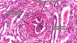 Rapidly Progressive Glomerulonephritis RPGN [upl. by Nada166]