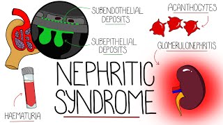 Understanding Nephritic Syndrome With Pathology Made Easy [upl. by Elcin]